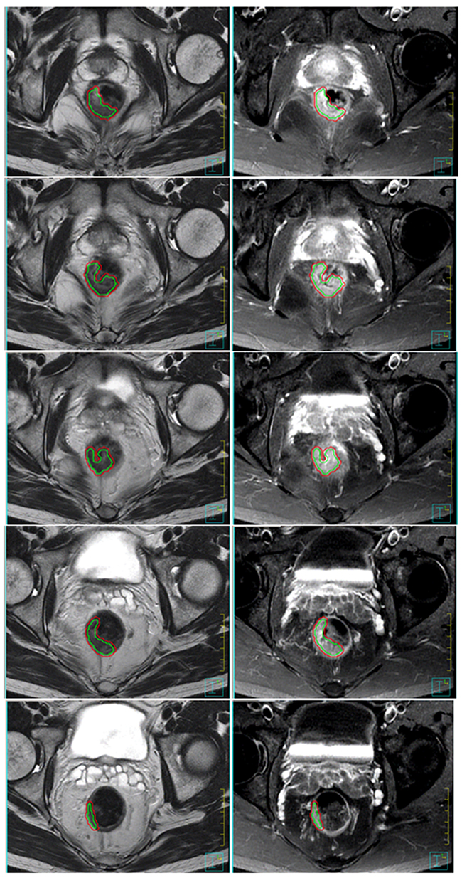 The rectal tumors of one patient are contoured as the ROI&#x005F;RTV on the axial images (here, T2-weighted and contrast-enhanced T1-weighted MRI) for each tumor-containing lesion.
