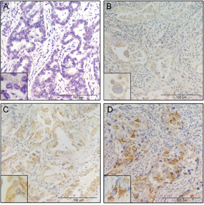 Representative IHC results of tumor specimens with different intensities of midkine staining.