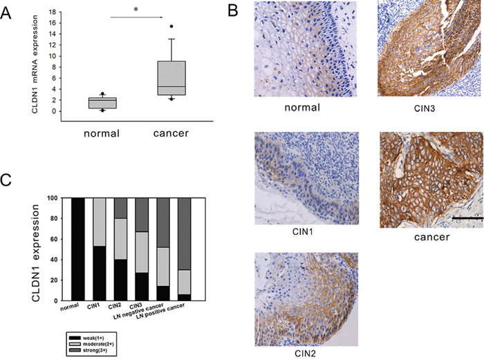 CLDN1 expression is increased in CIN and cervical cancer.