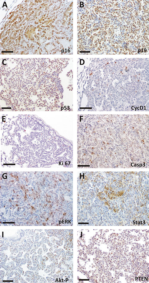 Immunohistochemical analysis of spontaneous tumorlets in TKO mice.