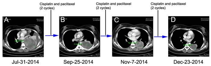 Chest CT scans documenting responses to cisplatin and paclitaxel (CP) chemotherapy.