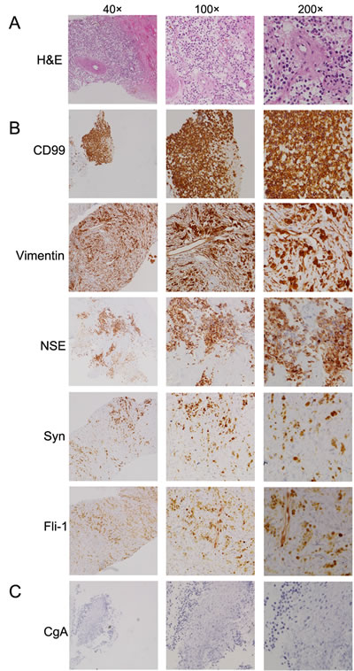 Histologic features of the pulmonary PNET.