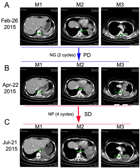 Chest CT scans documenting responses to nedaplatin and gemcitabine (NG) and nedaplatin and albumin-bound paclitaxel (NP) chemotherapies.