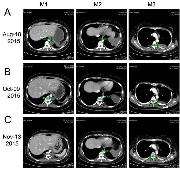 Chest CT scan documenting responses to Sunitinib.