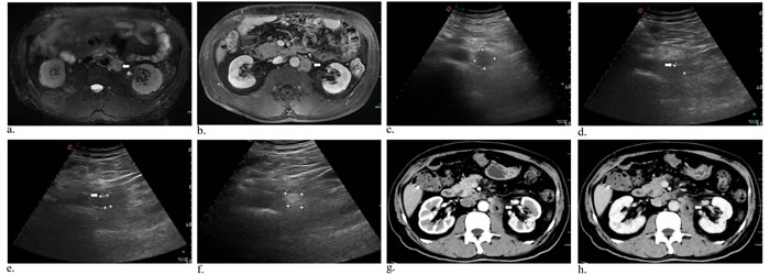 Metastasis of lymph nodes in a 60-year-old man who had undergone gallbladder cancer resection.