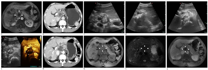 Axial abdominal MR image performed 13 days after initial ablation revealed the peripheral remanent tumor