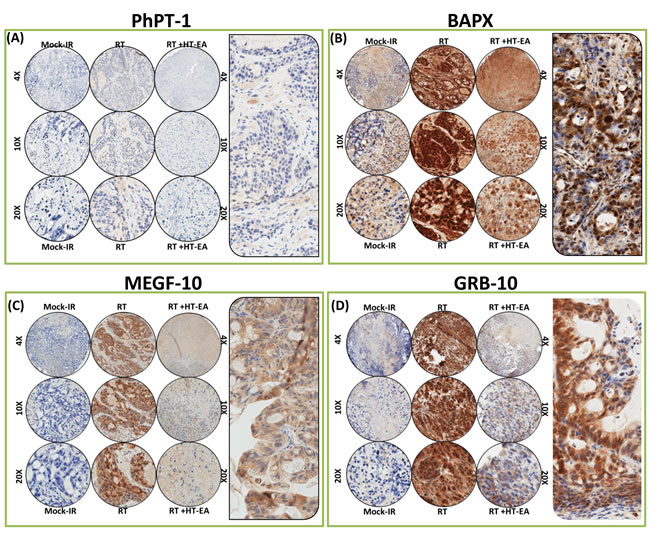 HT-EA mitigates RT-associated translation of PhPT-1, BAPX, MEGF-10, and GRB-10, in residual PC.