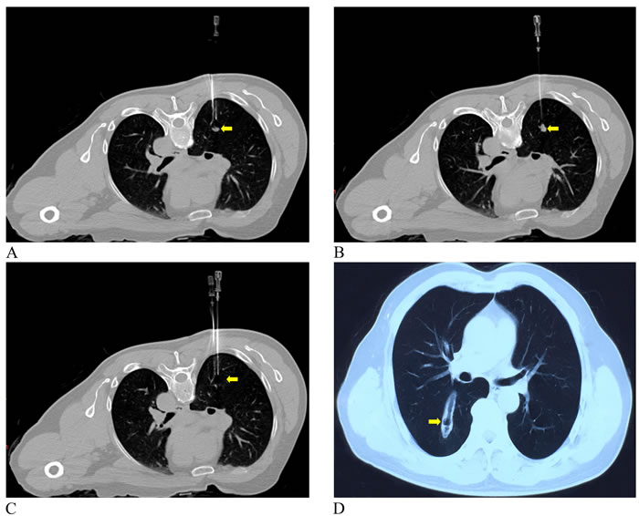 A 64-year-old man with lung metastasis from sigmoid colon cancer.