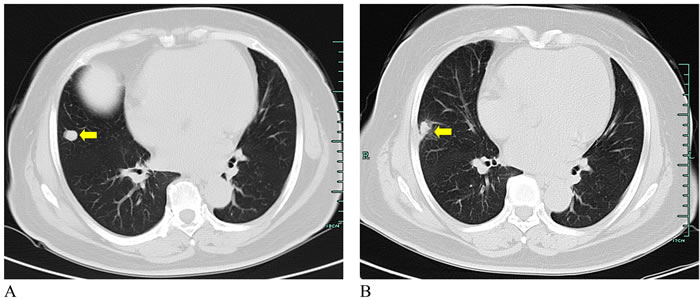 CT images from a 63-year-old woman with lung metastasis from sigmoid colon cancer.