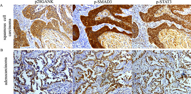 Correlation of Gankyrin expression with p-SMAD3 and p-STAT3 in NSCLC tissues using IHC.