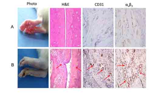 Histological changes in rheumatoid arthritis.