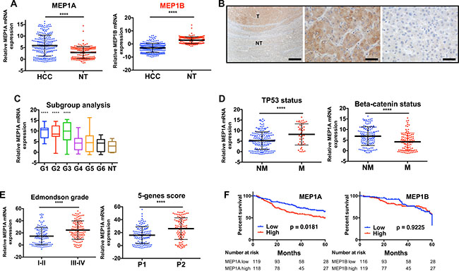 Meprin a is overexpressed in human HCC and its expression correlates with that of Reptin.