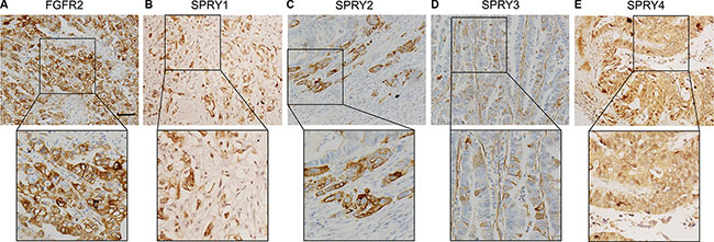 Representative figure of immunohistochemistry staining of high-expression of FGFR2 and SPRY family.