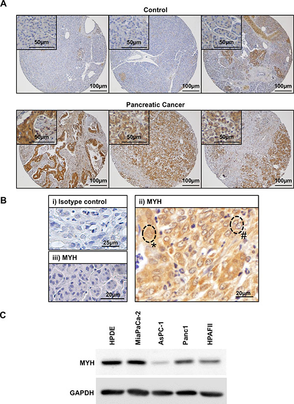 Expression of MYH in human pancreatic adenocarcinoma tissue and cell lines.