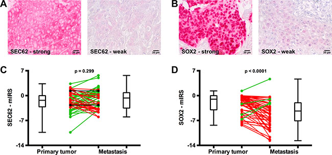 SEC62 and SOX2 expression in the primary tumor and lymph node metastases of HNSCC patients.