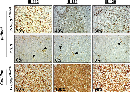 Immunohistochemical (IHC) staining against p-S6RPser240/244 and PTEN in leiomyosarcoma (LMS) disease tissues and cell lines.