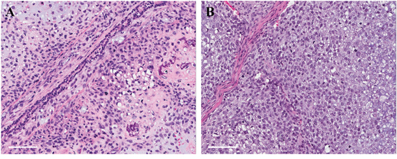 Hematoxylin and eosin (H&#x0026;E) staining of original patient tumor and mouse grown tumor.