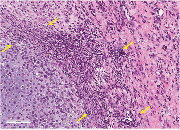 Effect of S. typhimurium on tumor histology.