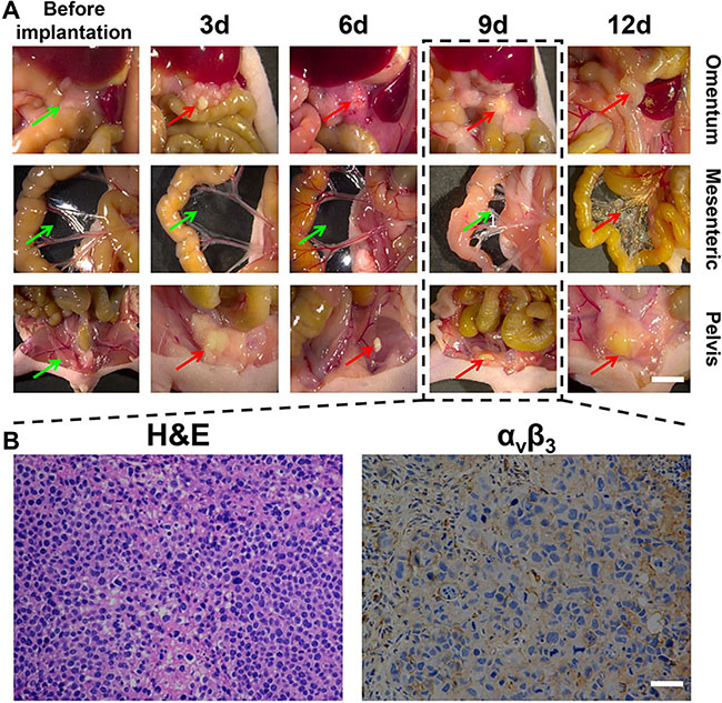 The dynamic and histological features of gastric cancer cell line SGC-7901 in peritoneal tumor formation.
