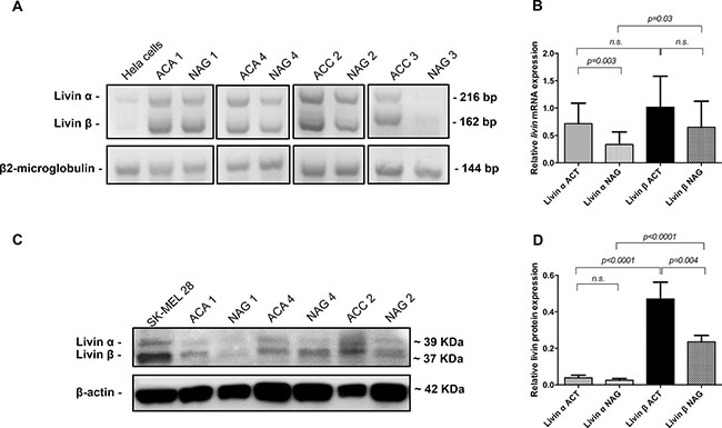 Expression of livin isoforms &#x03B1; and &#x03B2; in adrenocortical tumors and adjacent normal adrenal glands.