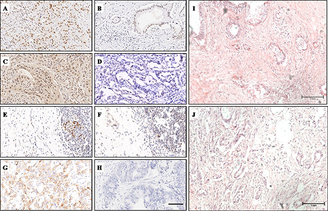 IHC and HE staining characteristics of MLH1, MSH2, PD-1, PD-L1 and stroma density.