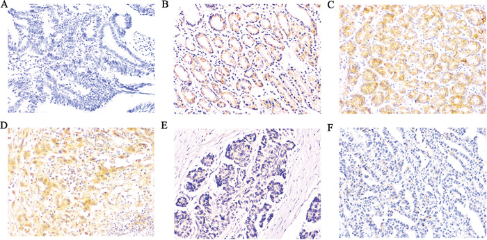 Immunohistochemical expression of Rap1GAP, E-cadherin and MMP2 in GC and para-carcinoma tissues.