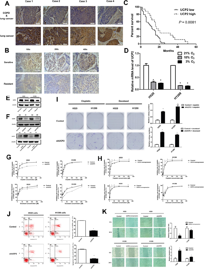 UCP2 downregulation contributed to NSCLC cell chemoresistance in hypoxia.
