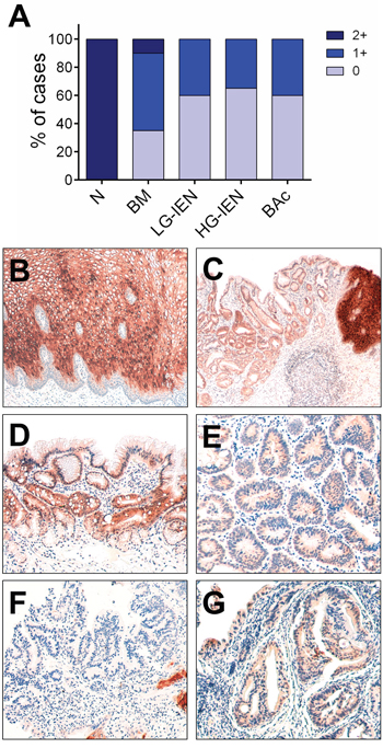 SCCA immunohistochemical expression during Barrett&#x2019;s carcinogenesis.