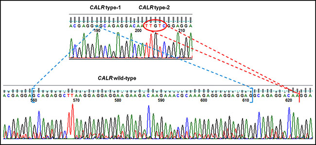 Sequencing chromatogram of patient with both CARL type-1 and 2 mutations compared with WT sequence.