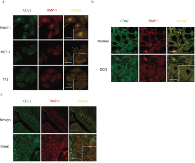 CD82 co-localizes with TIMP-1 in adenocarcinoma cells.