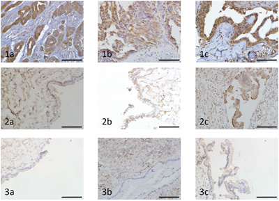Immunohistochemical analysis of Notch1, Jagged1 and NICD expression in ovarian carcinoma and benign ovarian tumour (original magnification &#x00D7;400, scale bar shows 50 &#x03BC;m).