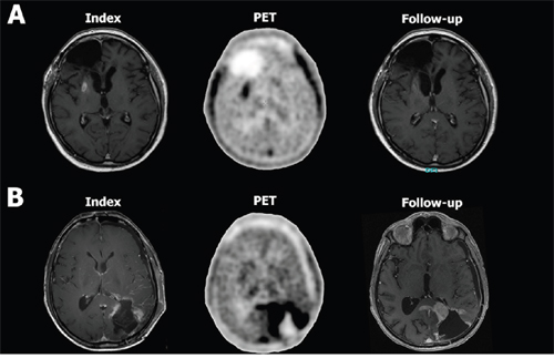 PET image with the corresponding MRI scans from a patient with pseudoprogression (patient 2, A) and true progression (patient 13, B).