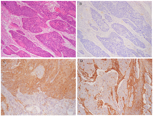 Representative microphotographs of sections from esophageal squamous cell carcinoma (ESCC).