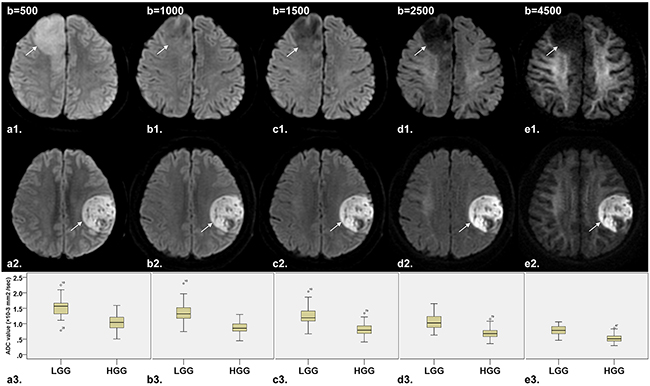 Comparison of DW images (b&#x003D;500, 1000, 1500, 2500 and 4500 sec/mm2, respectively) and corresponding box plot between LGG (diffuse astrocytoma in right frontal lobe, arrow) and HGG (glioblastoma in left frontal lobe, arrow).