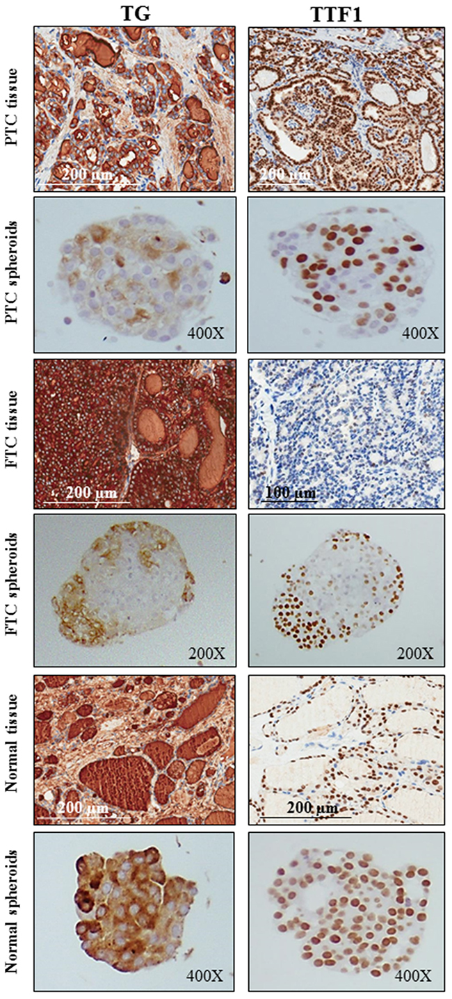 The expression of thyroid differentiation cell markers is maintained in spheroids derived from PTCs, FTCs and normal thyroid tissues.