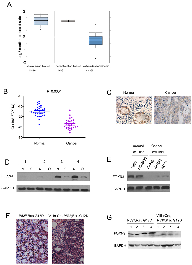 The expression of FOXN3 was decreased in colon cancer.