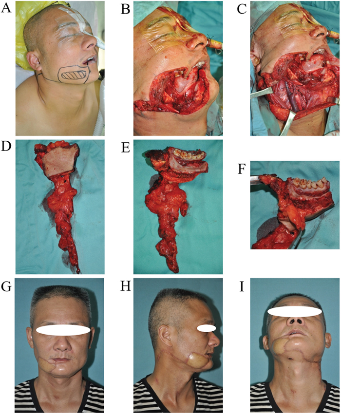 URBS of buccal cancer located below the line of occlusion.