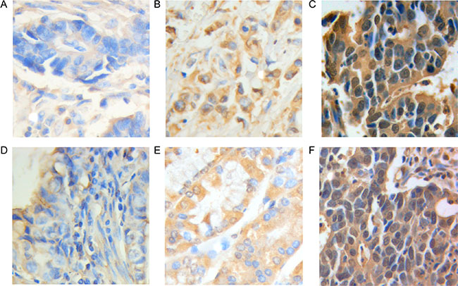 Kaplan&#x2013;Meier curves for overall survival of prognosis in 349 patients with gastric adenocarcinoma.