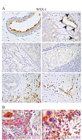 Immunohistochemical localization of WSX-1 in normal and neoplastic human prostate tissues.