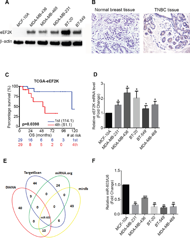 Figure 1. eEF2K protein and mRNA is overexpressed in TNBC cell lines and patients tumor samples.