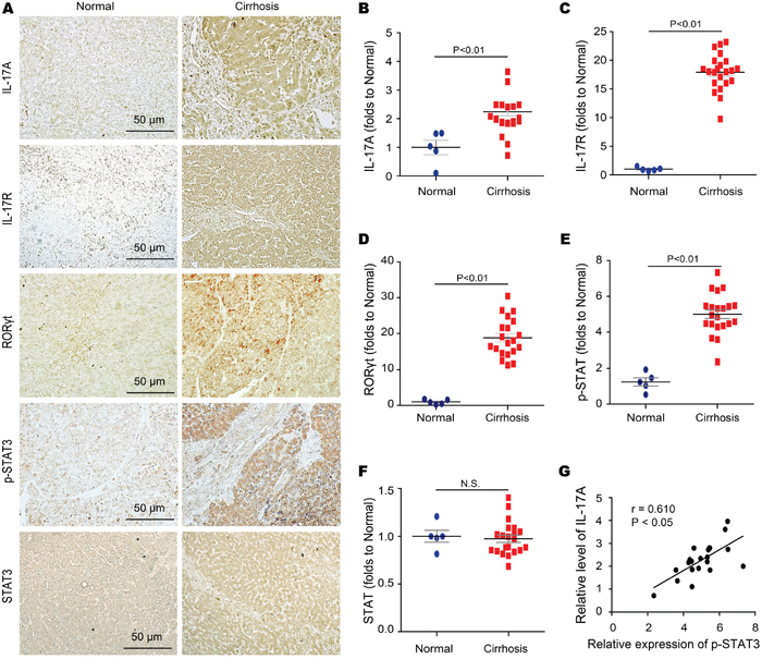 STAT3 phosphorylation correlates with the activated IL-17A signaling in human fibrotic liver tissues.