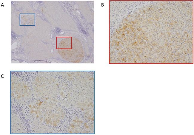 Representative immunohistochemical staining of glypican-3 (GPC3) in HCC.