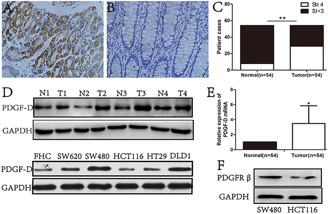 PDGF-D was high expression in CRC tissues and cell lines.