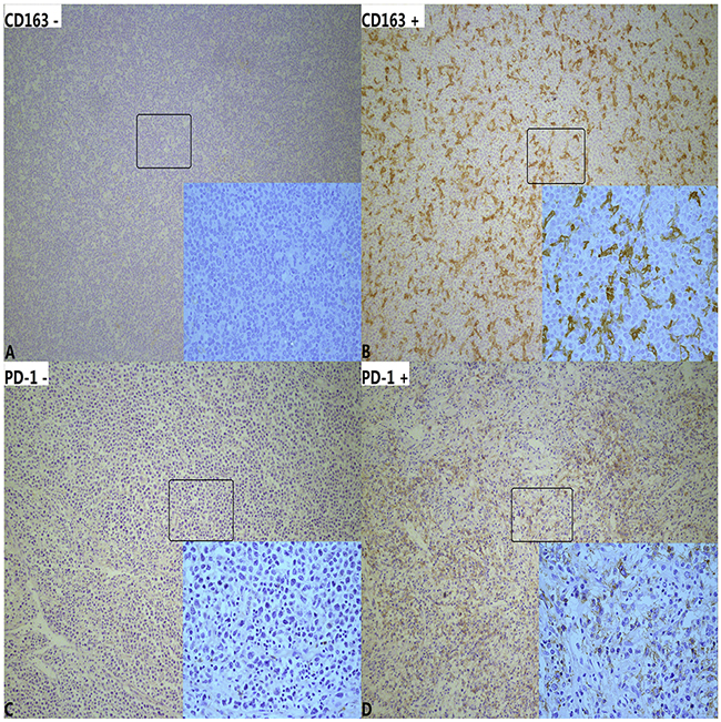Immunohistochemical staining of tumor-associated macrophages (TAM) and PD-1+ tumor-infiltrating lymphocytes(TILs) in diffuse large B-cell lymphoma (100&#x00D7;HPF and 400&#x00D7;HPF).