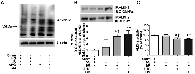 Hyperglycemia increased myocardial ALDH2 O-GlcNAc modification and decreased its activity after myocardial ischemia/reperfusion in rats.
