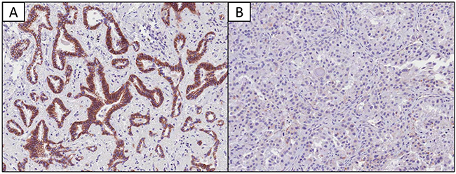 Immunohistochemical findings regarding E-cadherin expression in lung adenocarcinomas.