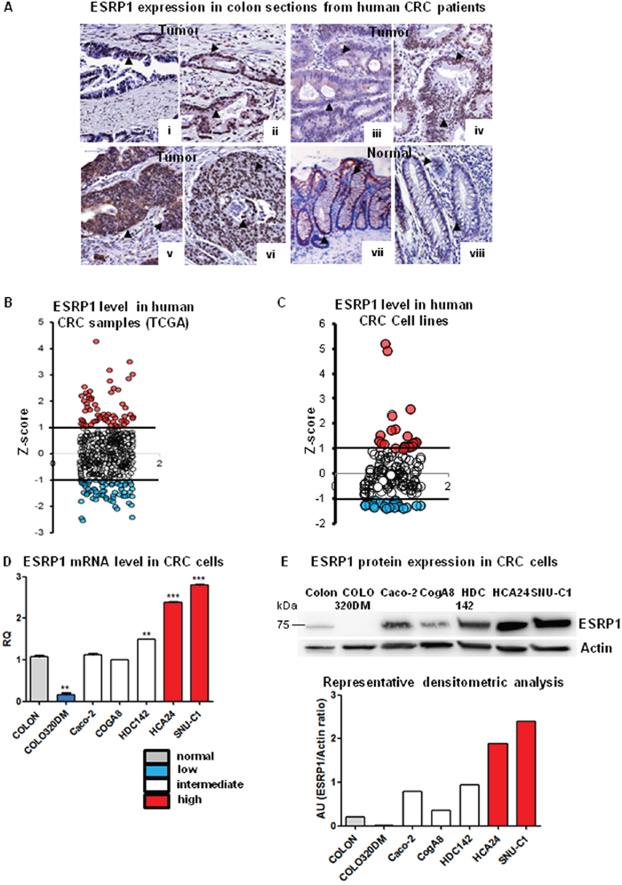 ESRP1 expression in CRC patients and cell lines.