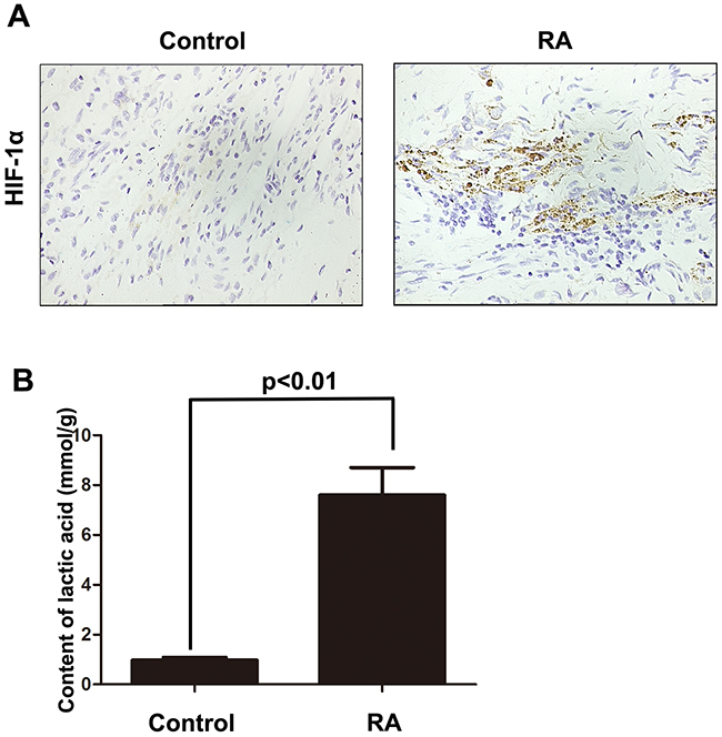 The expression of HIF-1&#x03B1; was significantly up-regulated in rheumatoid arthritis tissue.