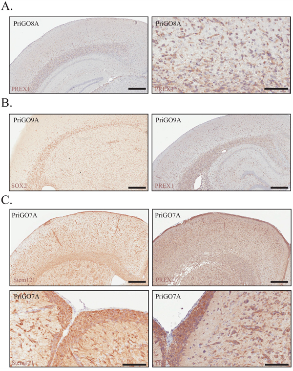 PREX1 expression in glioblastoma tumour xenografts.