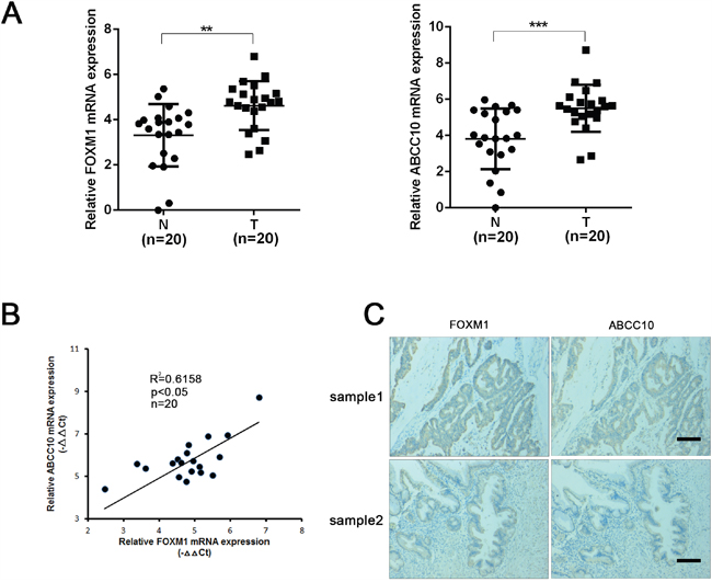 The level of FOXM1 and ABCC10 are correlated in CRC patient tissues.